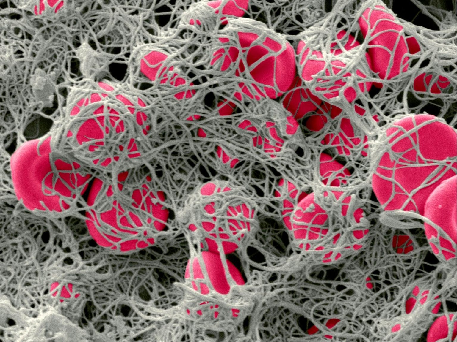 Media Mystery of Ignoring Micro Blood Clots in Long COVID