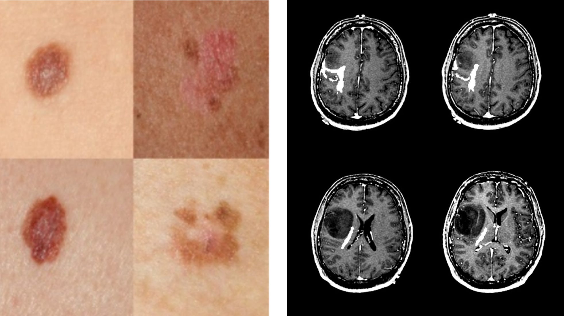 Why skin lesions are peanuts and brain tumors harder nuts