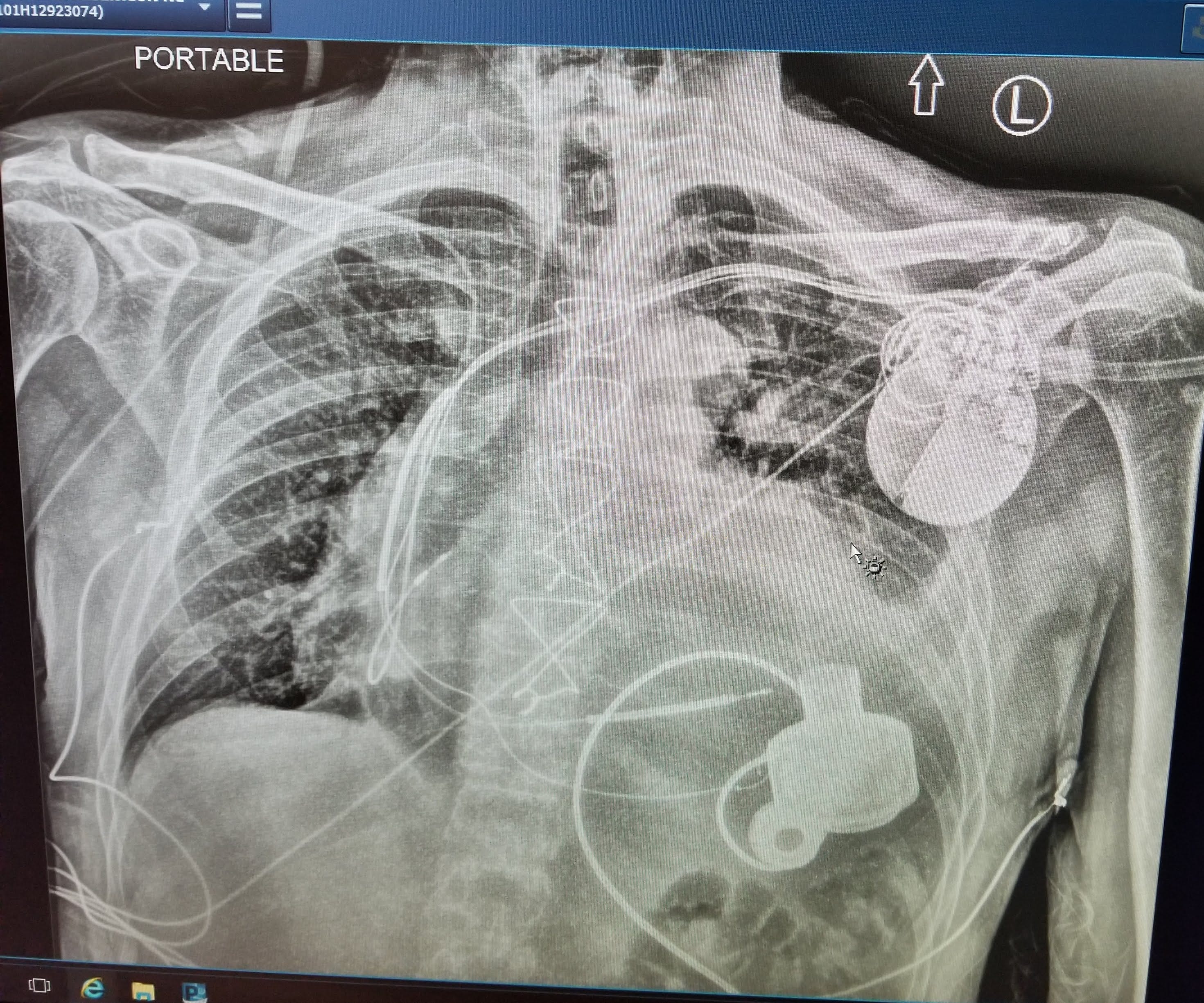 LVAD Life Vol 1 By Matt Matusiak LVADMat s Newsletter lvad-life-vol-1-by-matt-matusiak-lvadmat-s-newsletter