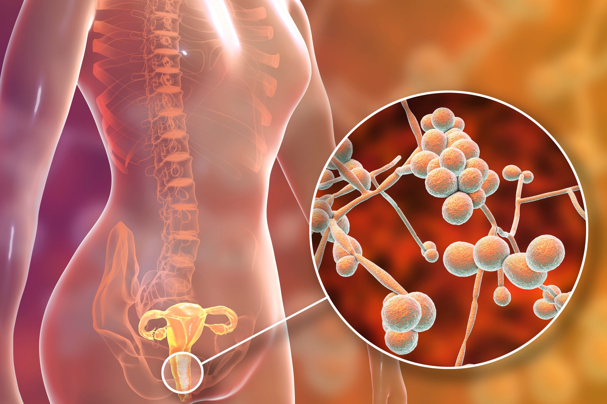 Can you use monistat store with a copper iud