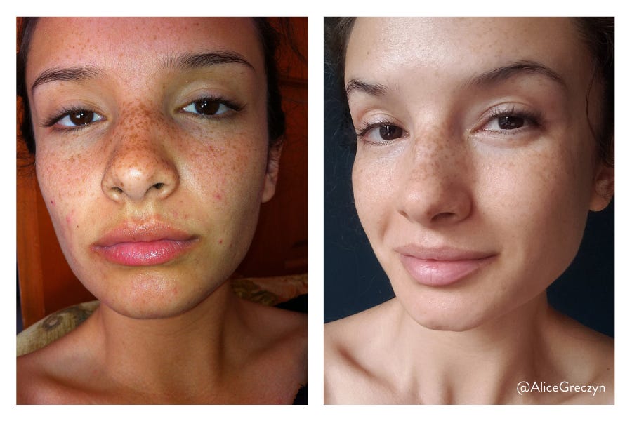 Perioral on sale dermatitis moisturizer