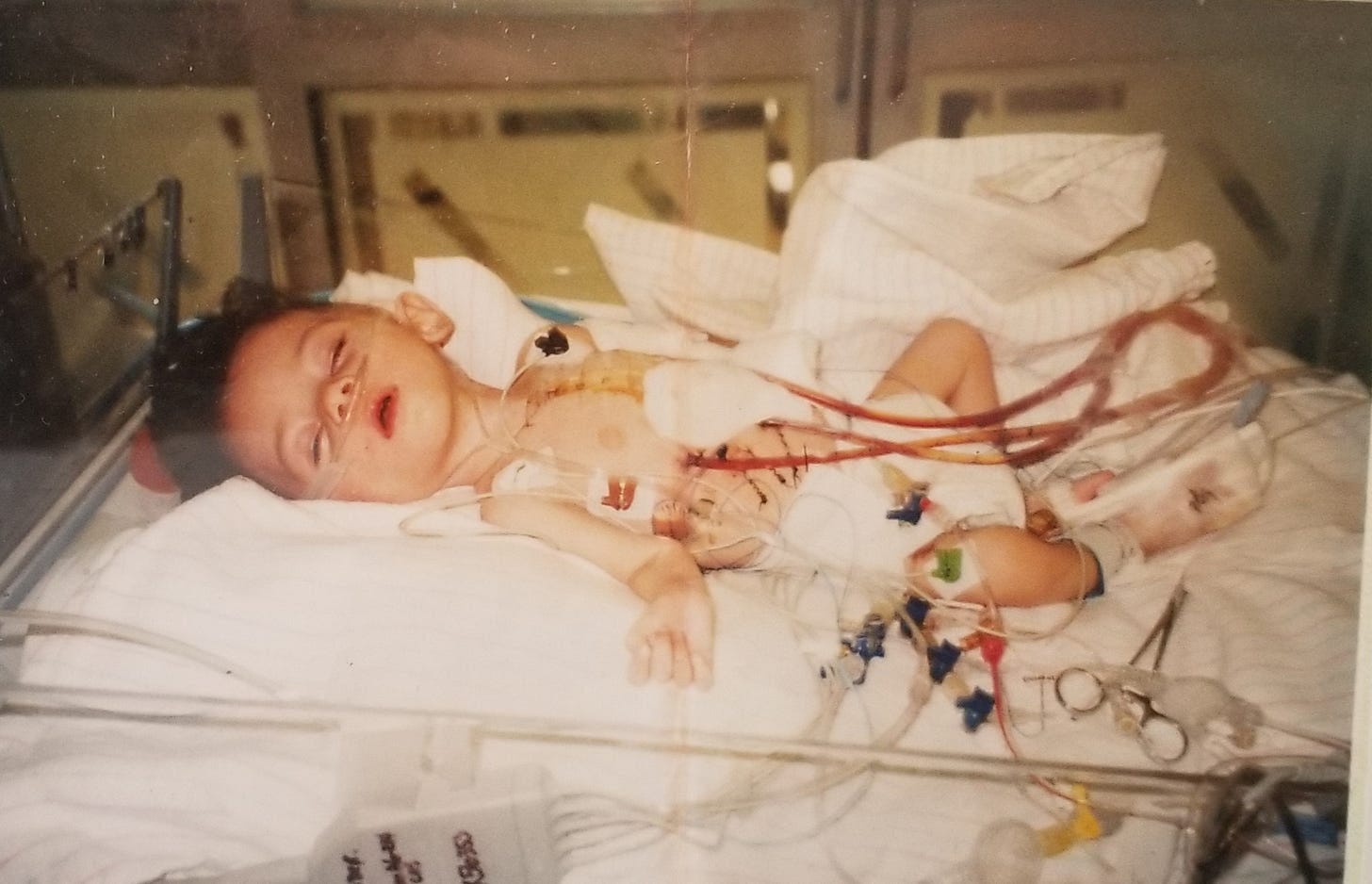 removal of thymus organs during heart surgery