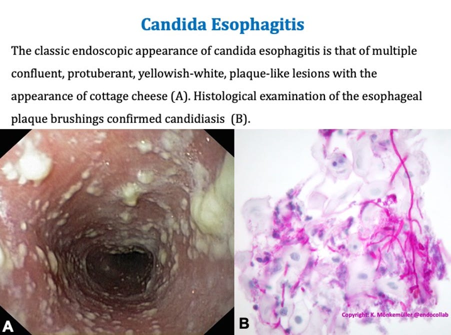 Candida Esophagitis by Klaus Mönkemüller