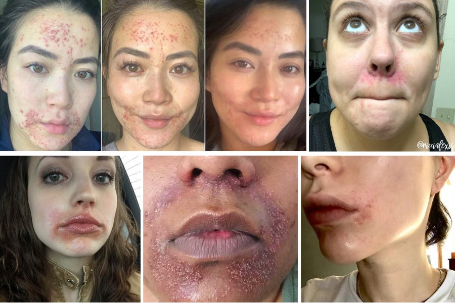 Perioral deals dermatitis moisturizer
