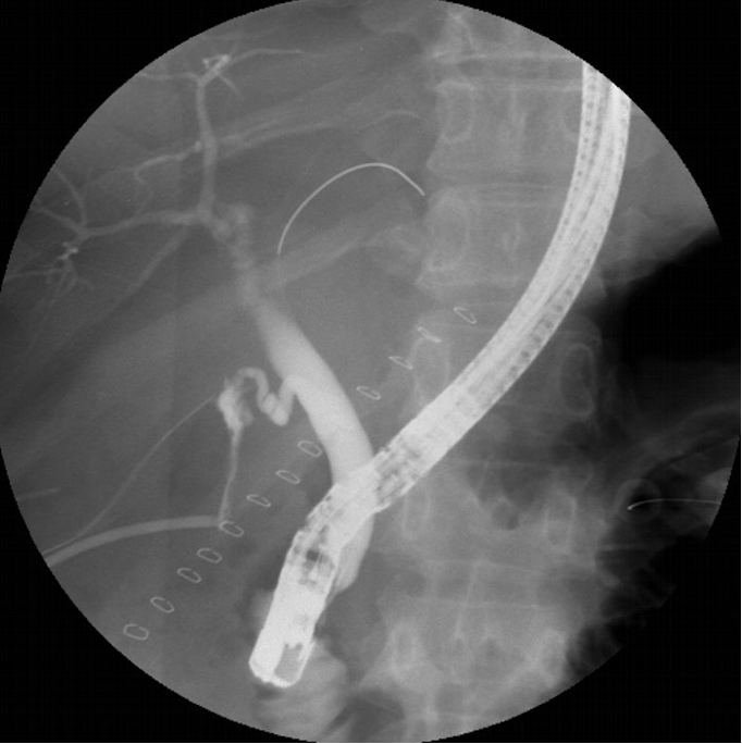 Handling PostOperative Common Bile Duct Leaks
