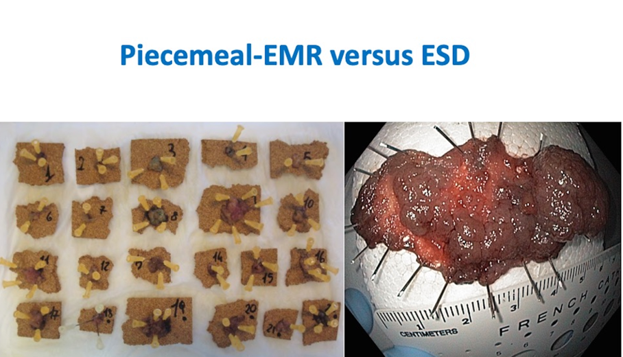 Is Endoscopic Submucosal Dissection (ESD) Ready to Enter CenterStage for the Resection of Large