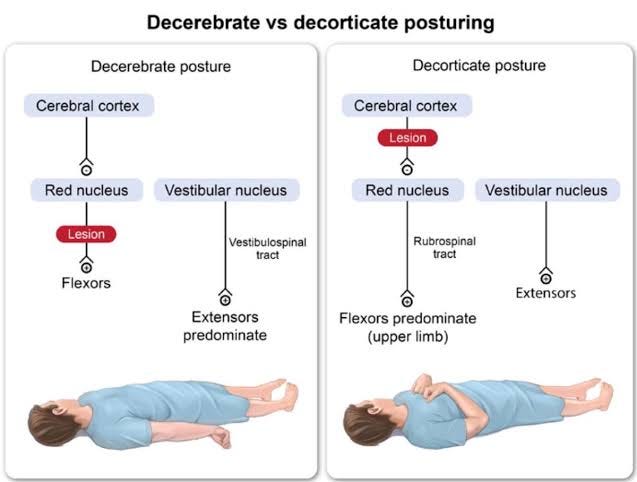 Decorticate Vs Decerebrate Posturing   Cefdee44 A303 4349 83dd D9c1e4fb1fef 637x482 