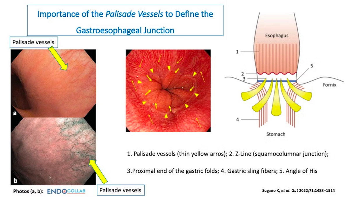 What are the Palisade Veins? by Klaus Mönkemüller