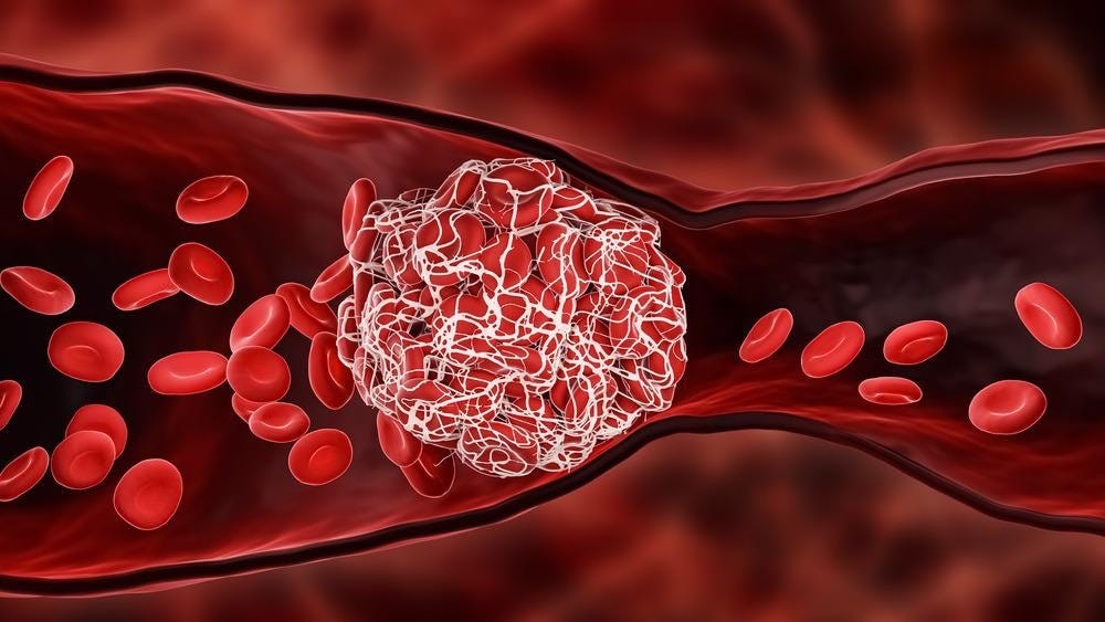 Exclusive CDC Lists Blood Clots in the Brain as a Side Effect to the