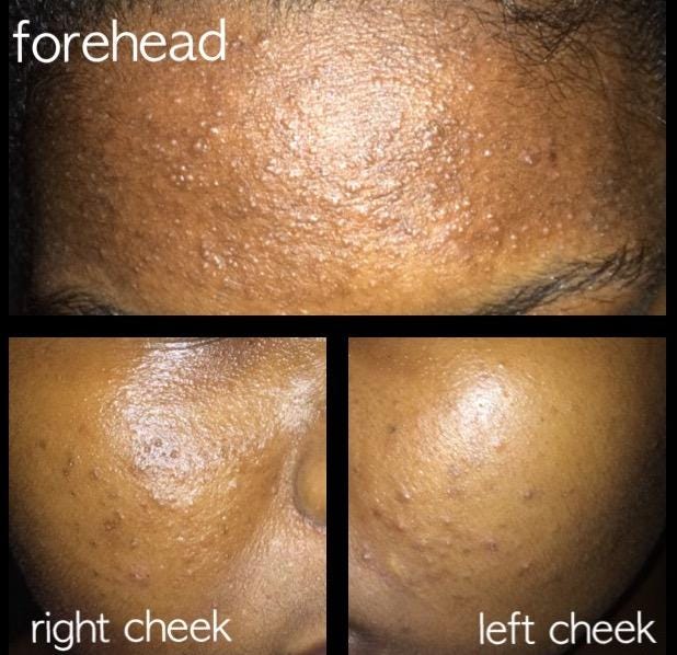 Best moisturizer for shop closed comedones