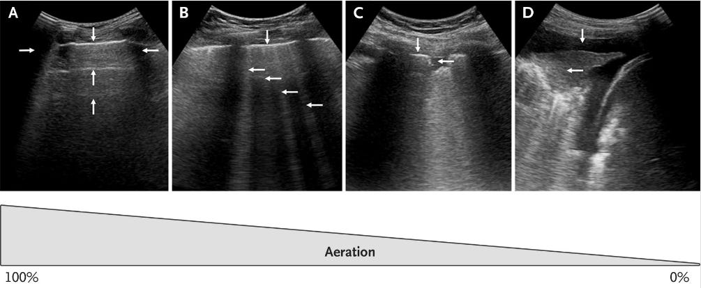 Como avaliar congestão pulmonar?