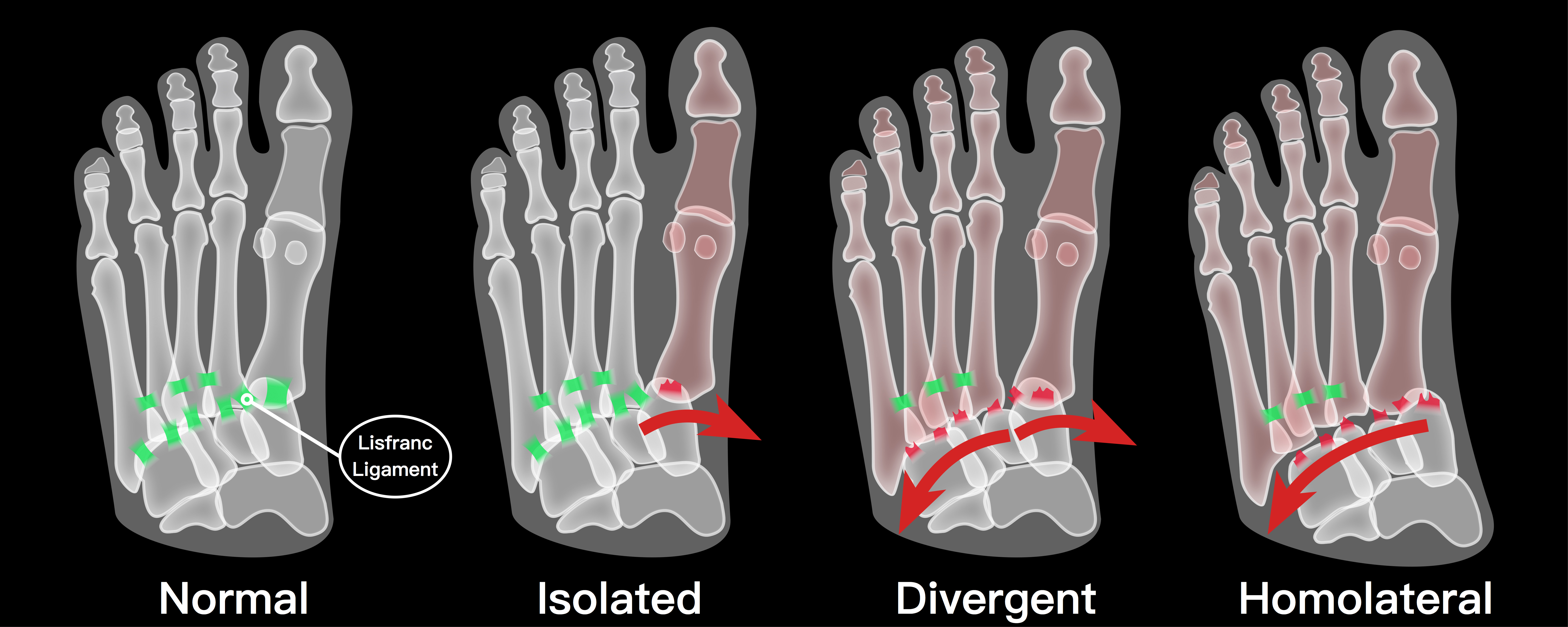 How Lisfranc Injuries Affect Fantasy Football (Najee, Bateman)