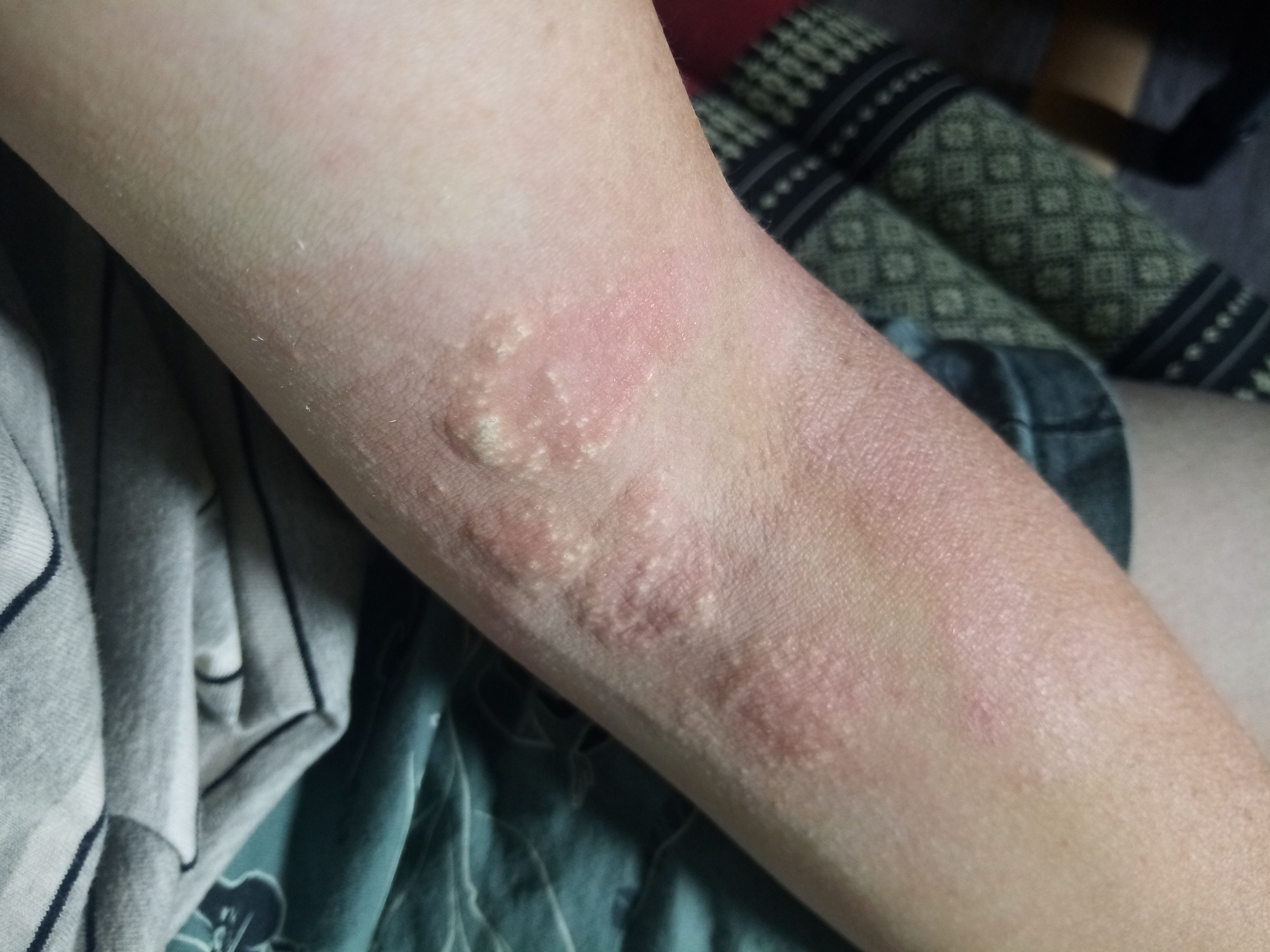 Peroxide 'eczema' update Kiwi in the Crowd