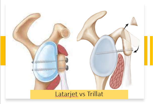 An update for the art of shouldering SHOULDERS!