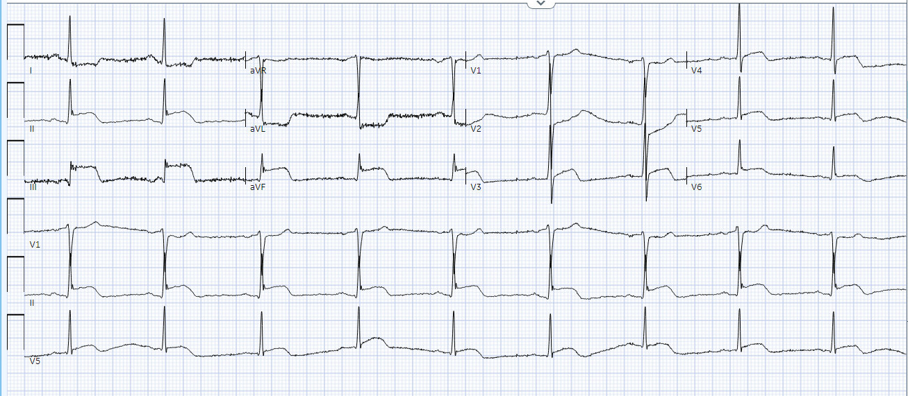 #2 - Knowing What to Expect from an Anterior versus Inferior Wall ...