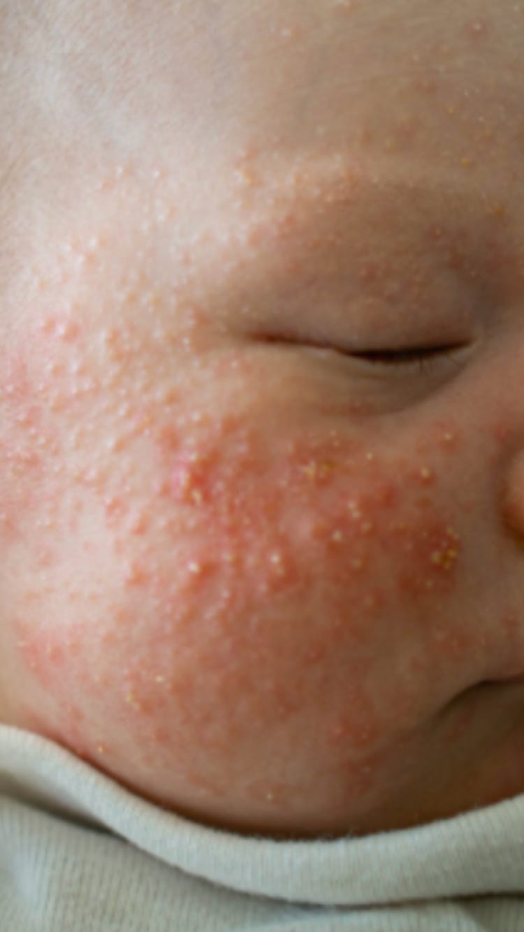 Hydrocortisone for baby 2025 acne