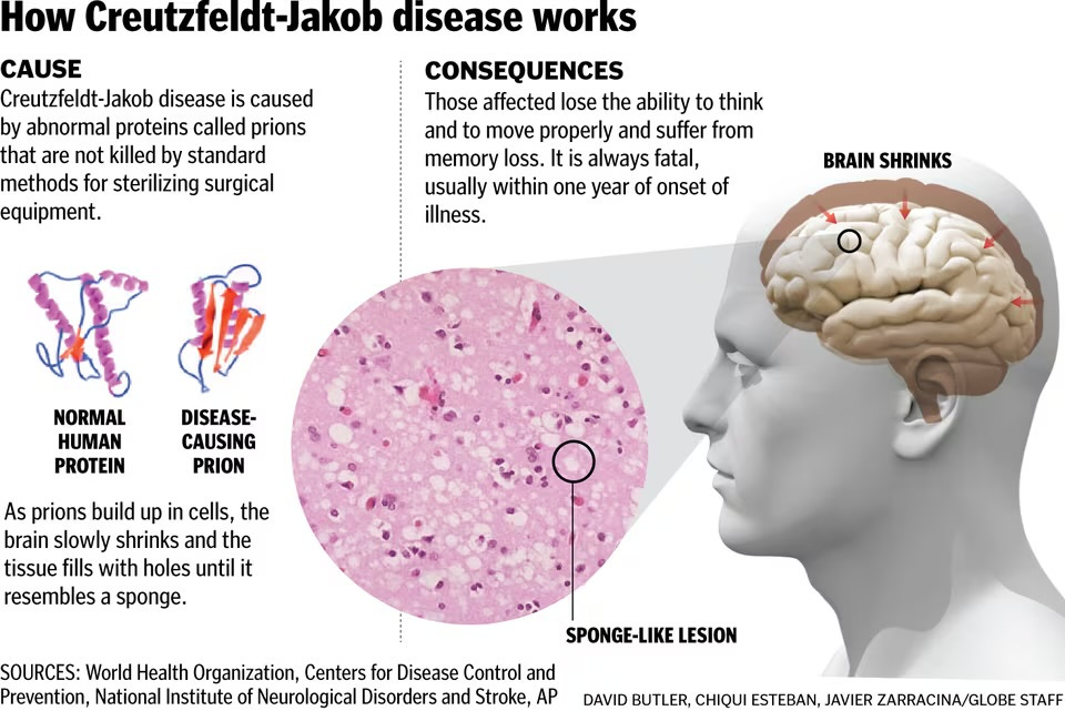 Covid shots associated with fatal CreutzfeldtJakob disease (CJD) are