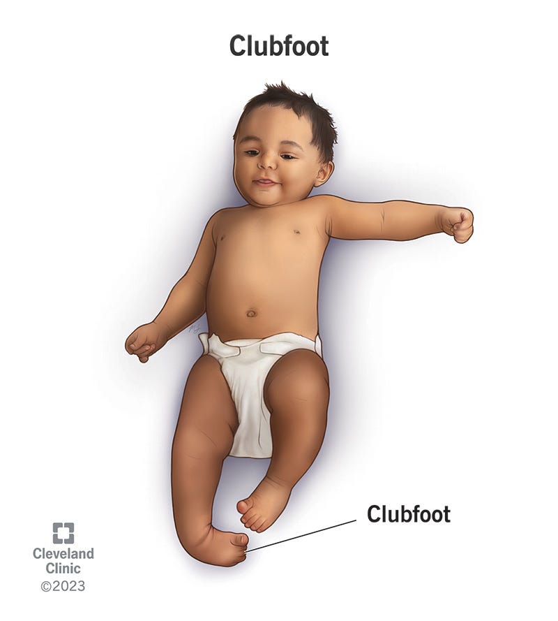 Orthotic Management of Clubfoot: The Basics - by Nicki CS
