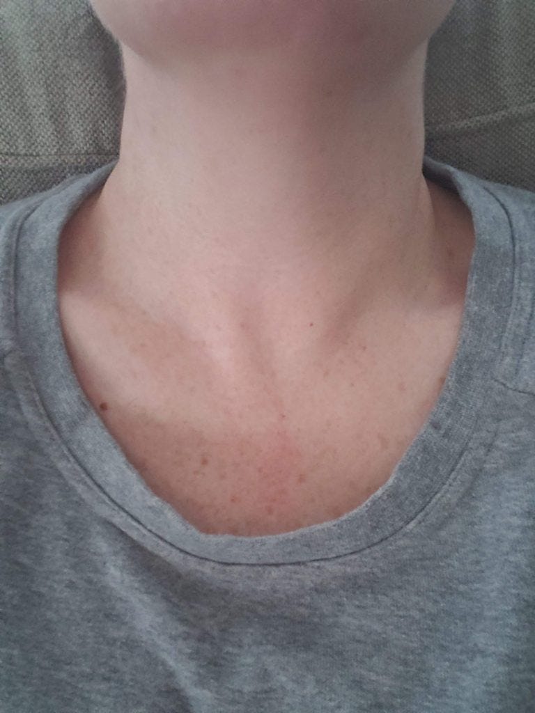 My personal catastrophe/RFA follow-up - by Jennifer Holkem