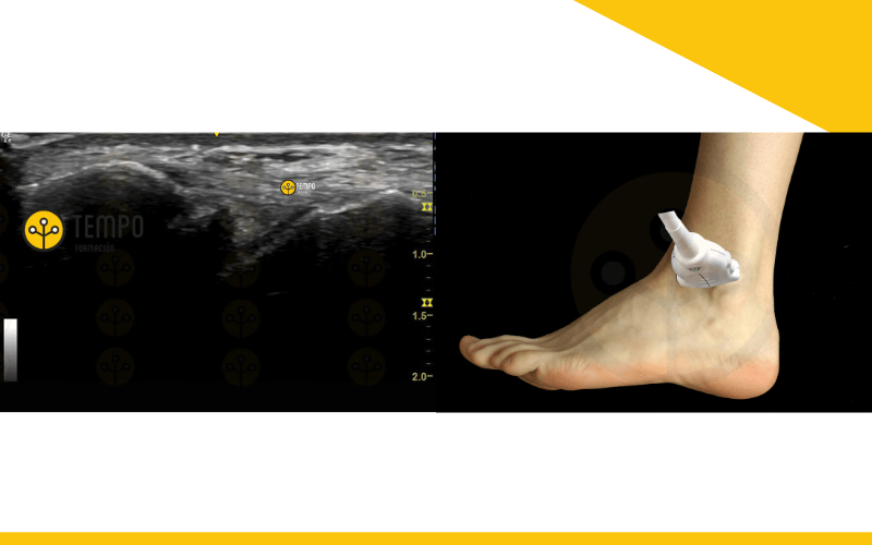 ligamento-peroneo-astragalino-anterior-by-tempo-formaci-n