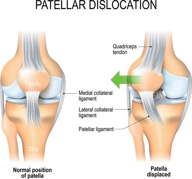 Mpfl Layers Medial Patellofemoral Ligament (MPFL) Reconstruction: Part 1