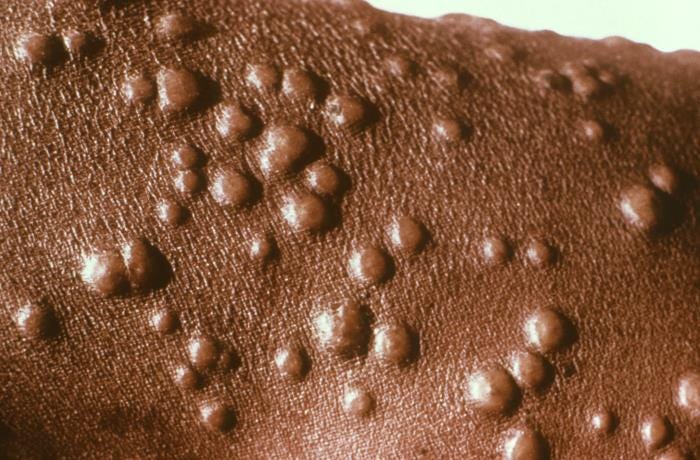 Smallpox and the Decline of Bioterrorism Safety