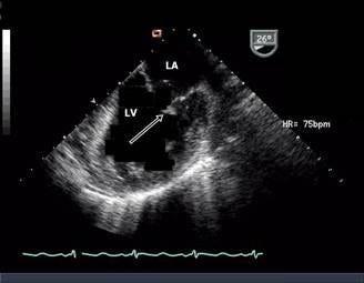 #3A - Knowing What to Expect from an Anterior versus Inferior Wall ...