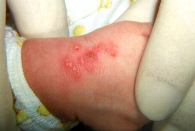 Vesicular Rash Infant Pediatric Pearls. TORCH Infections: Herpes Simplex Neonatorum (HSV)