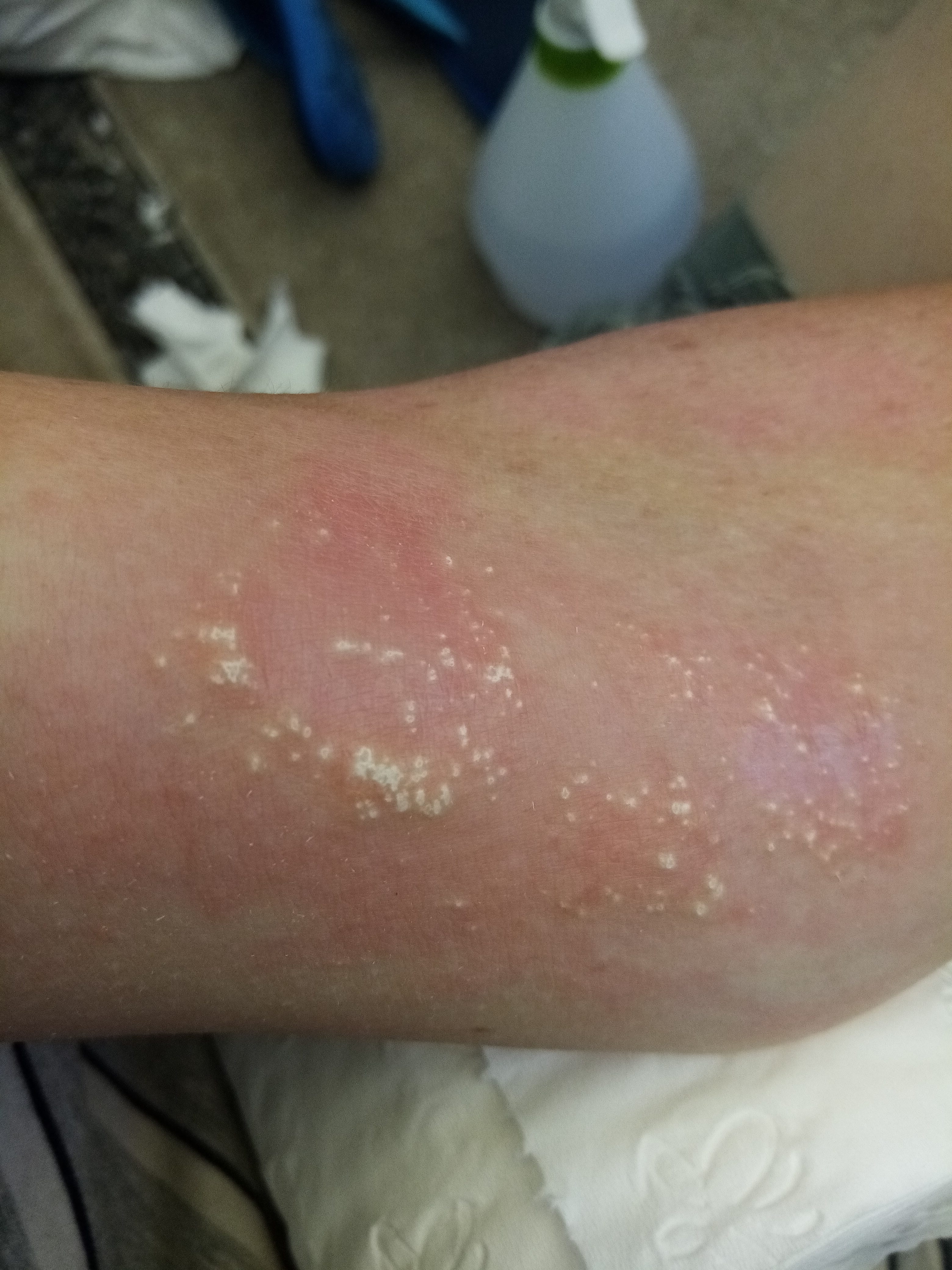 Peroxide 'eczema' update Kiwi in the Crowd