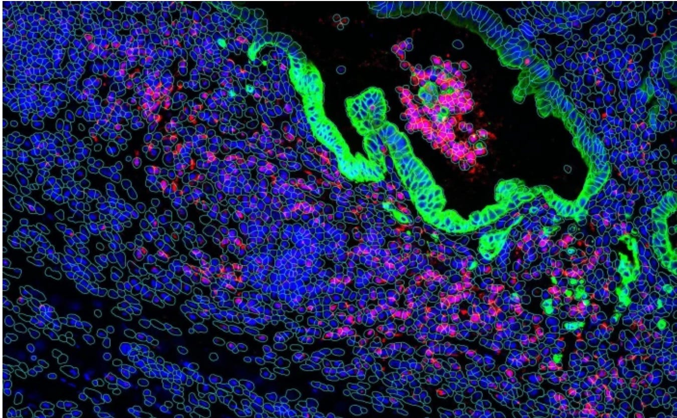 Decoding Cancer Complexity via the Largest Multi Omic Spatial Atlas