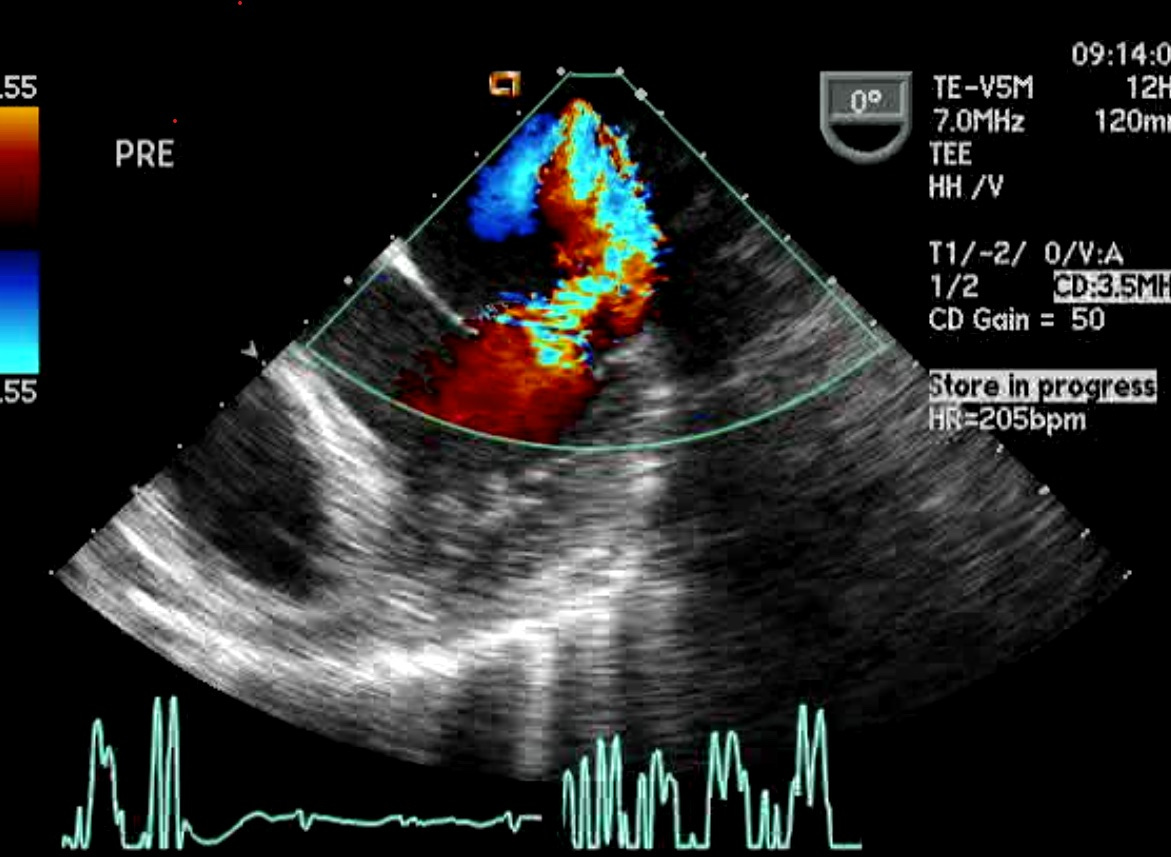 #3B - Knowing What to Expect from an Anterior versus Inferior Wall ...
