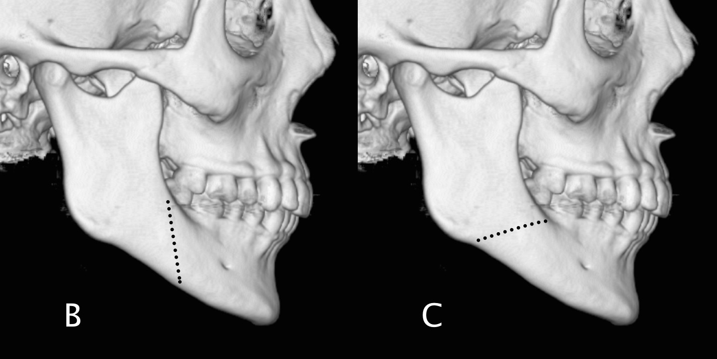 Mandible fracture by Alexander Baxter RadNotes