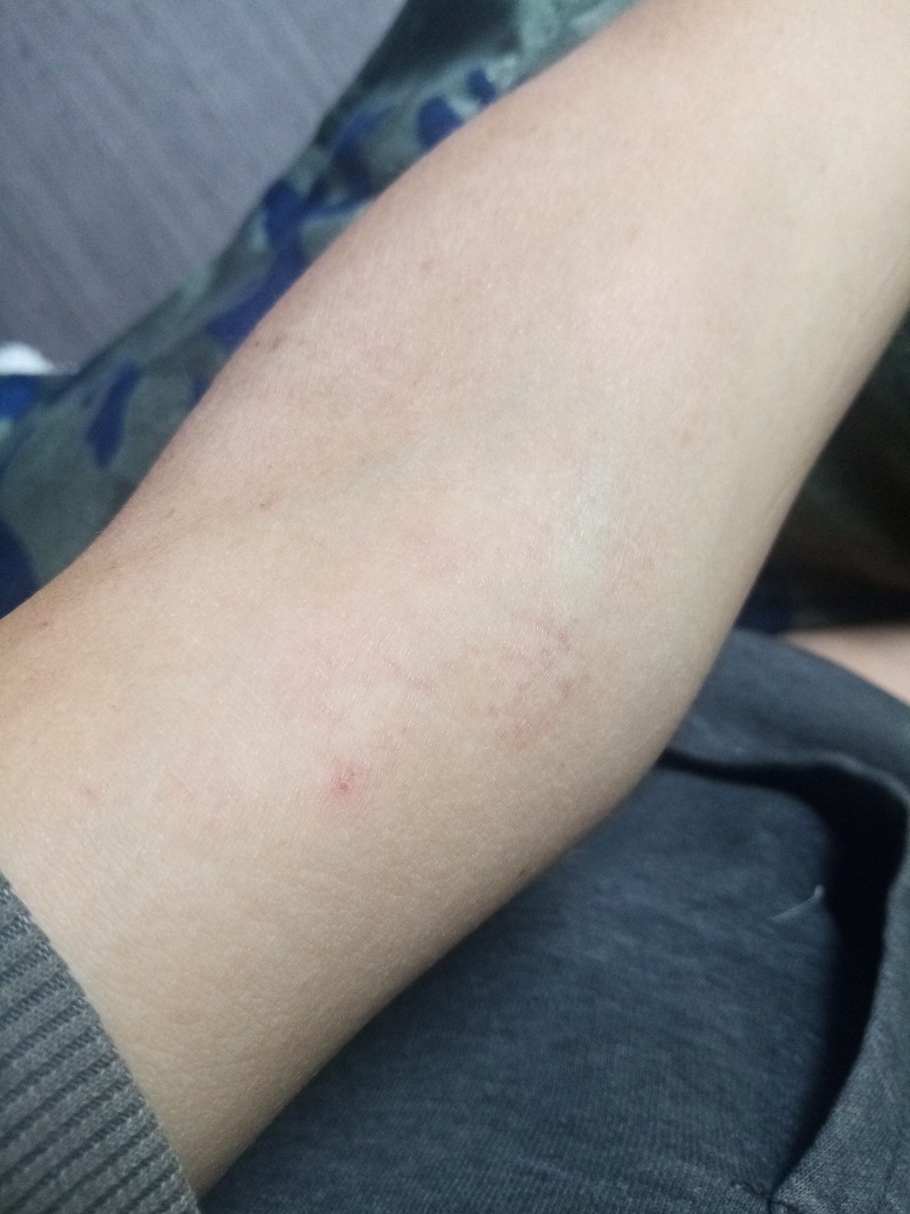 Peroxide 'eczema' update Kiwi in the Crowd