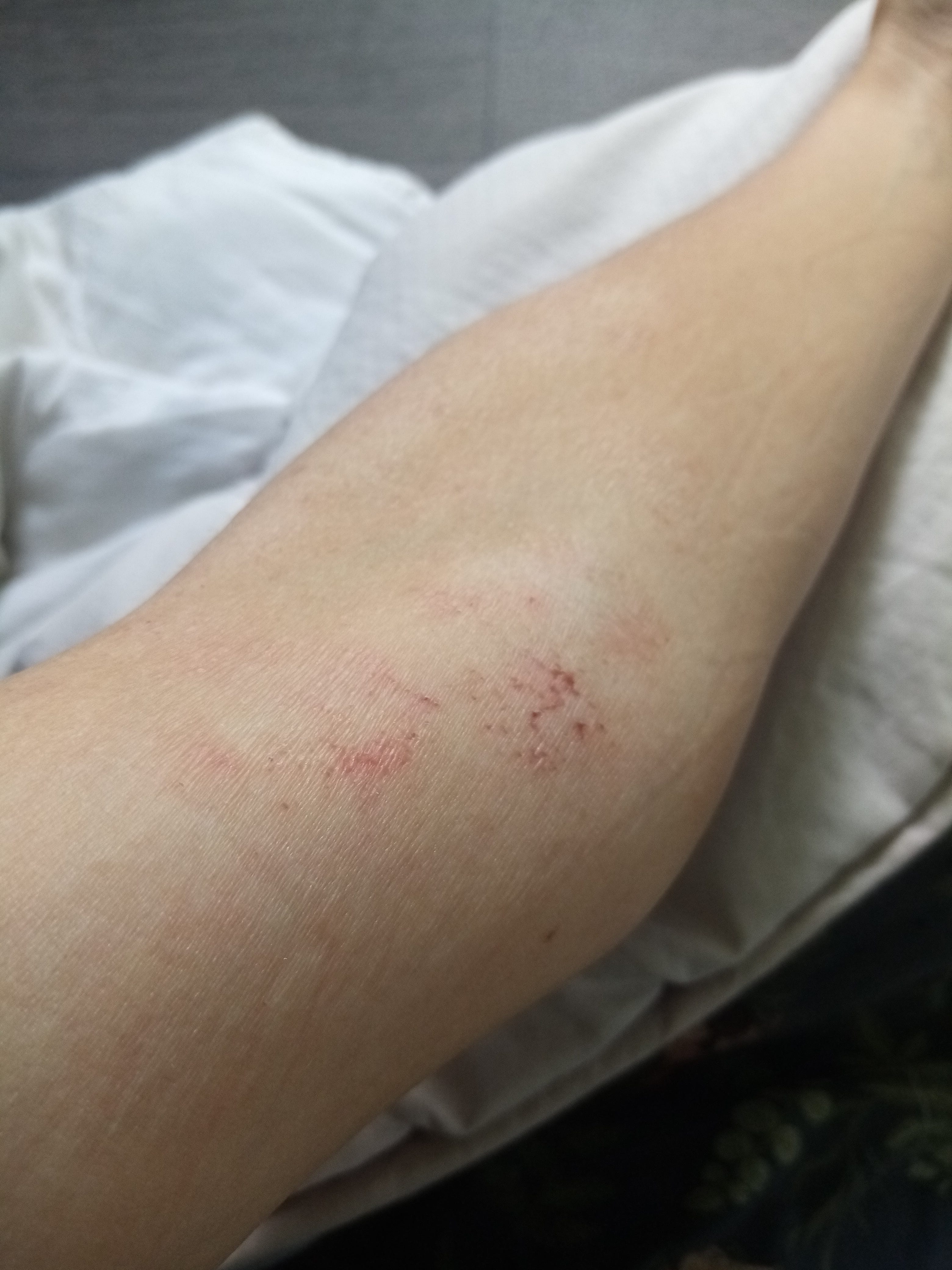 Peroxide 'eczema' update Kiwi in the Crowd