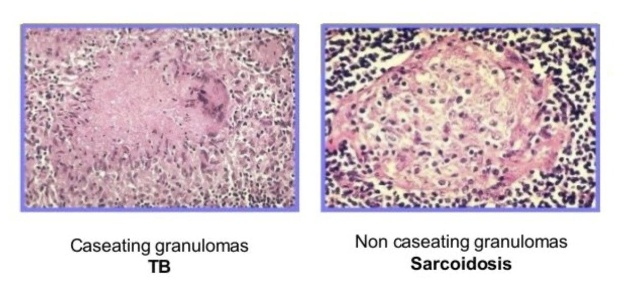Pathology Images to Know for USMLE Step 1