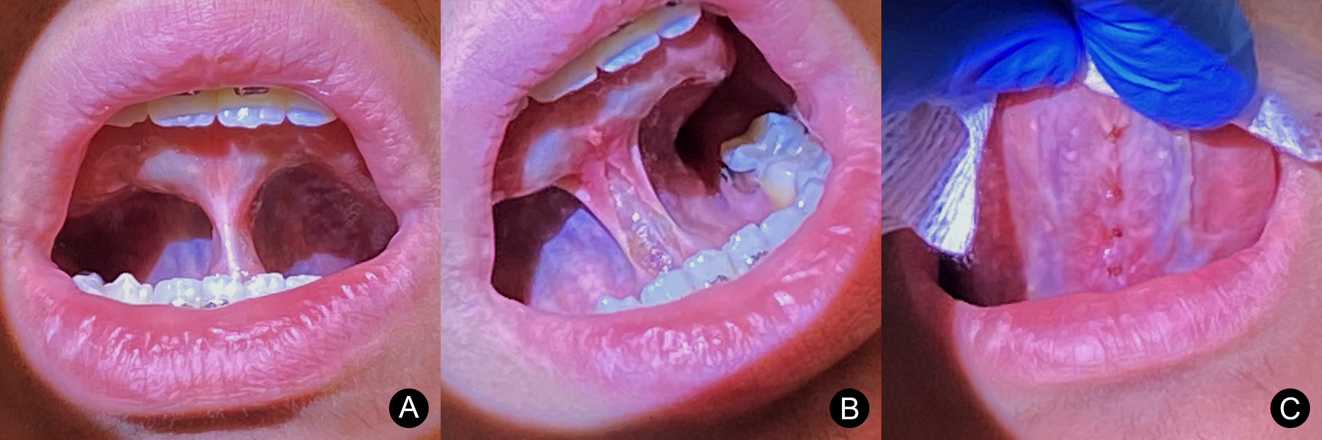 3.2 Tongue Tie Release by Ronald Ead JawHacks
