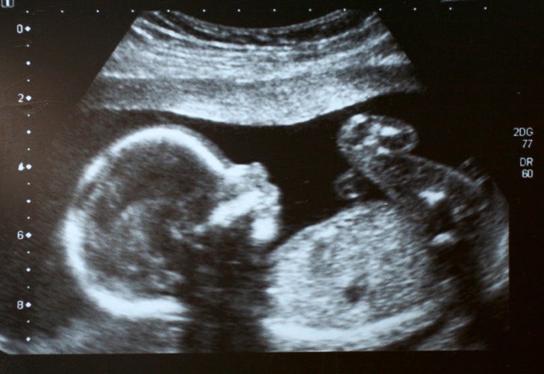 A foetus ultrasound.