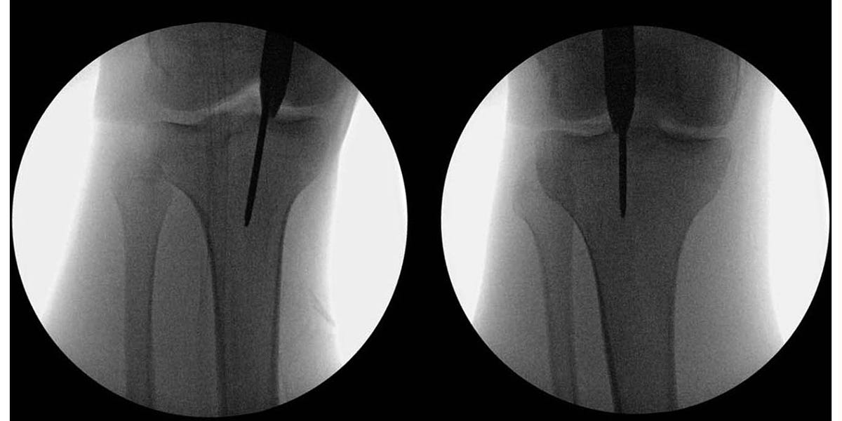 6: Extra-articular proximal tibial fractures: nail or plate? - Document -  Gale OneFile: Health and Medicine