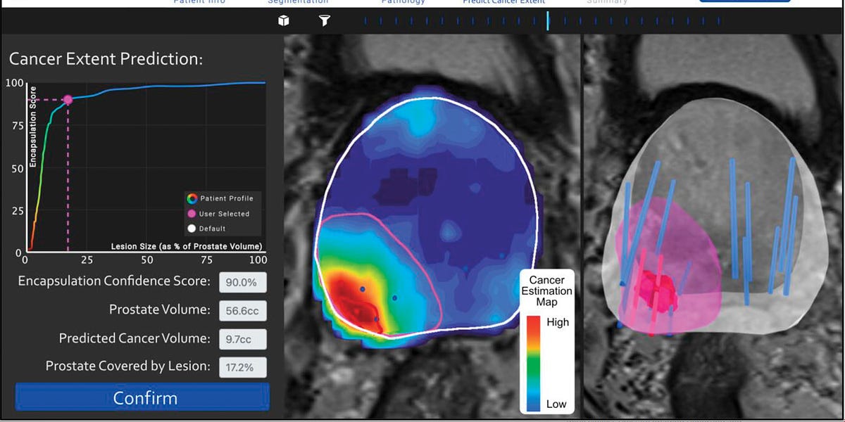 Artificial Intelligence detects cancer with Better than Doctors 🎗️