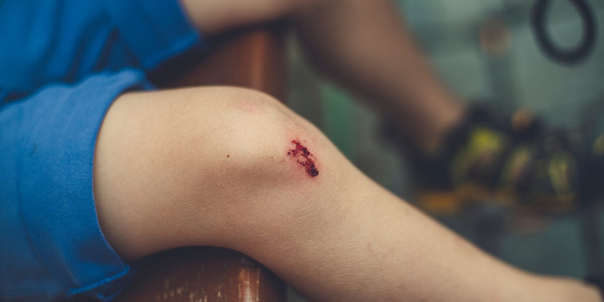 Vitamin K Deficiency Caused by Vitamin A toxicity