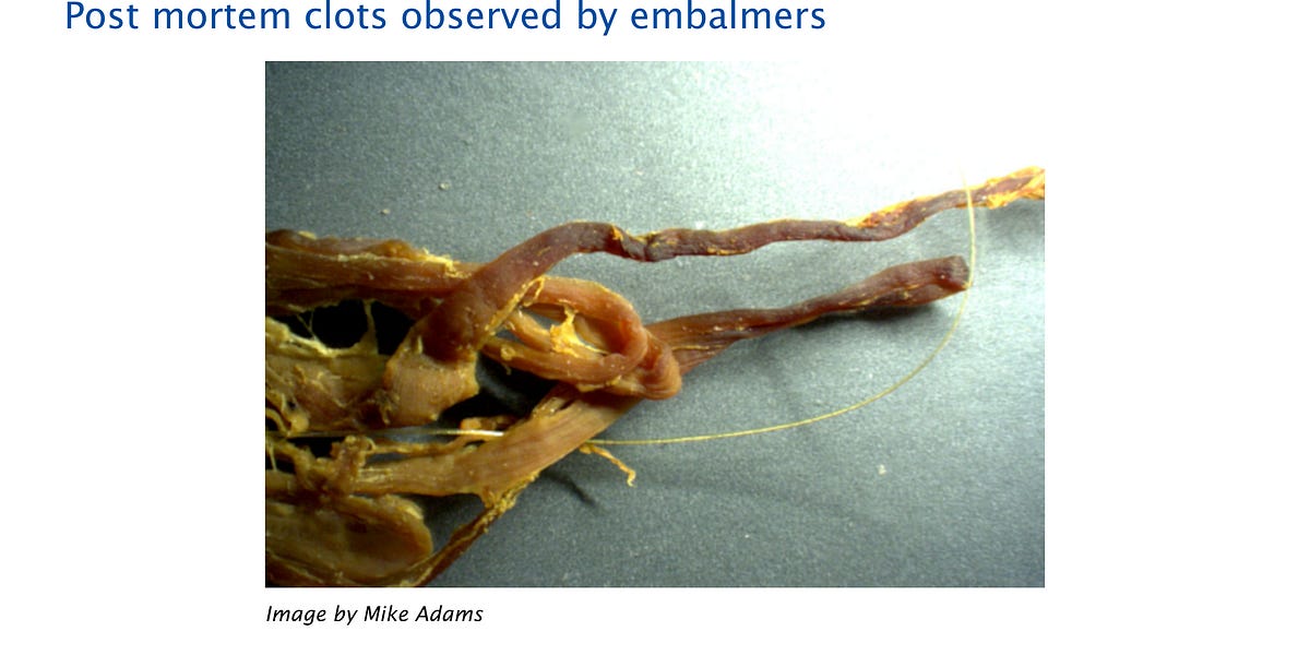 Never-Before-Seen Abnormal Blood Clots in COVID-19 Vaccinated Patients