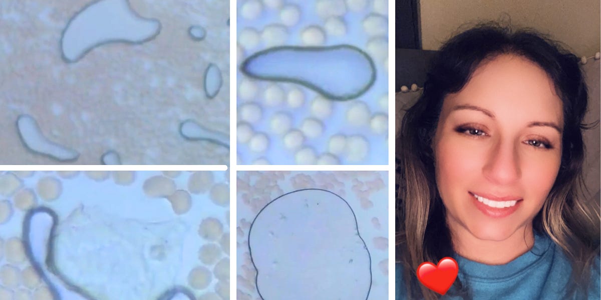 Hydrogel-Like Substance Found in Vaccine-Injured Nurse’s Blood