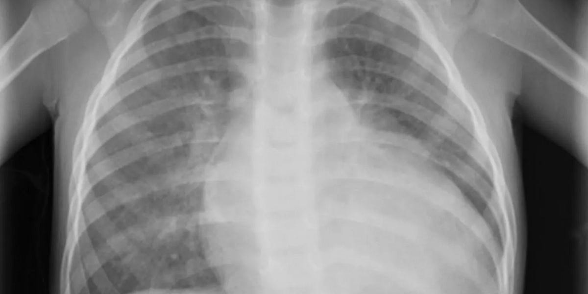 Report 94: Pfizer Secretly Studied a Heart Damage Marker, Troponin I, in Five- to 15-Year-Olds, Following mRNA COVID Vaccination in 2021.