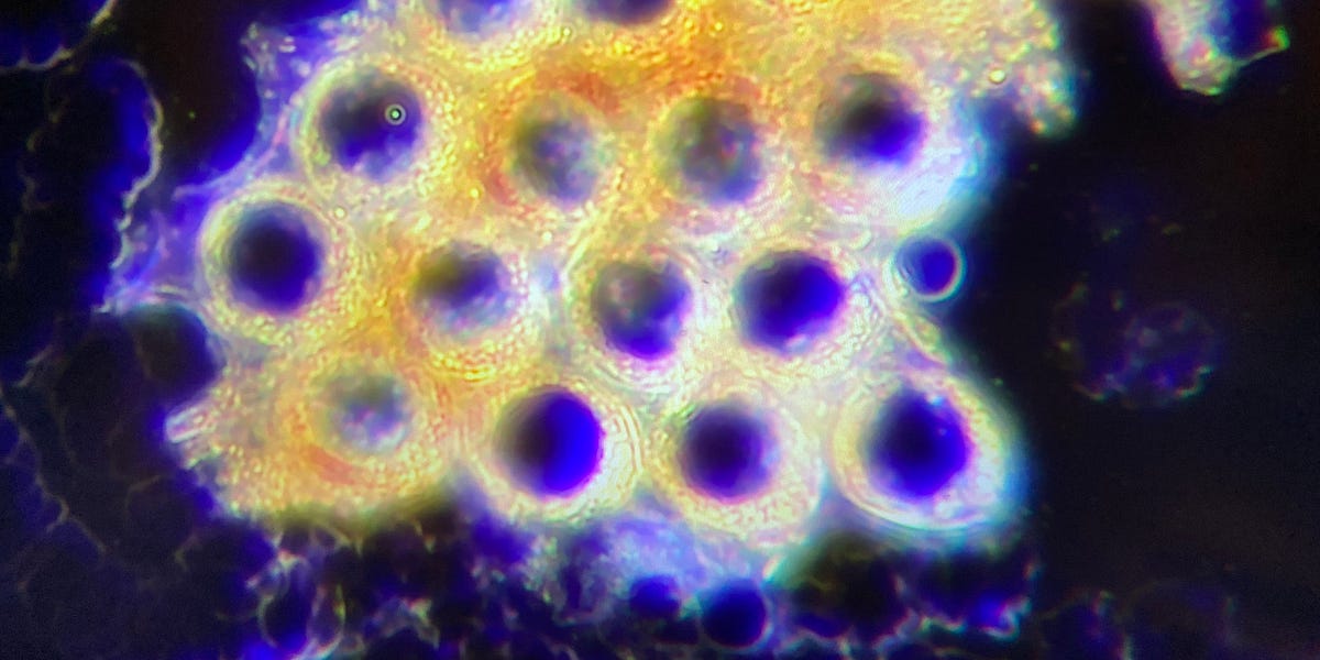 Nose & Sinus excretions, Metals in Blood and Geoengineering