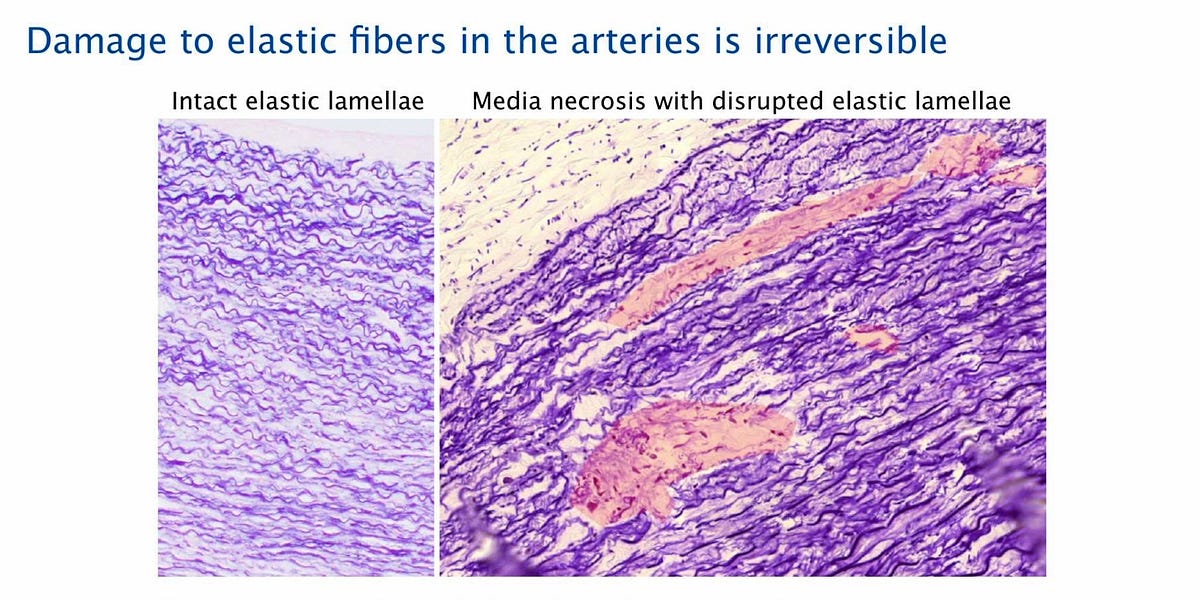 Rapid Aging, Scaring of the Arteries: A Side Effect of the COVID Injections