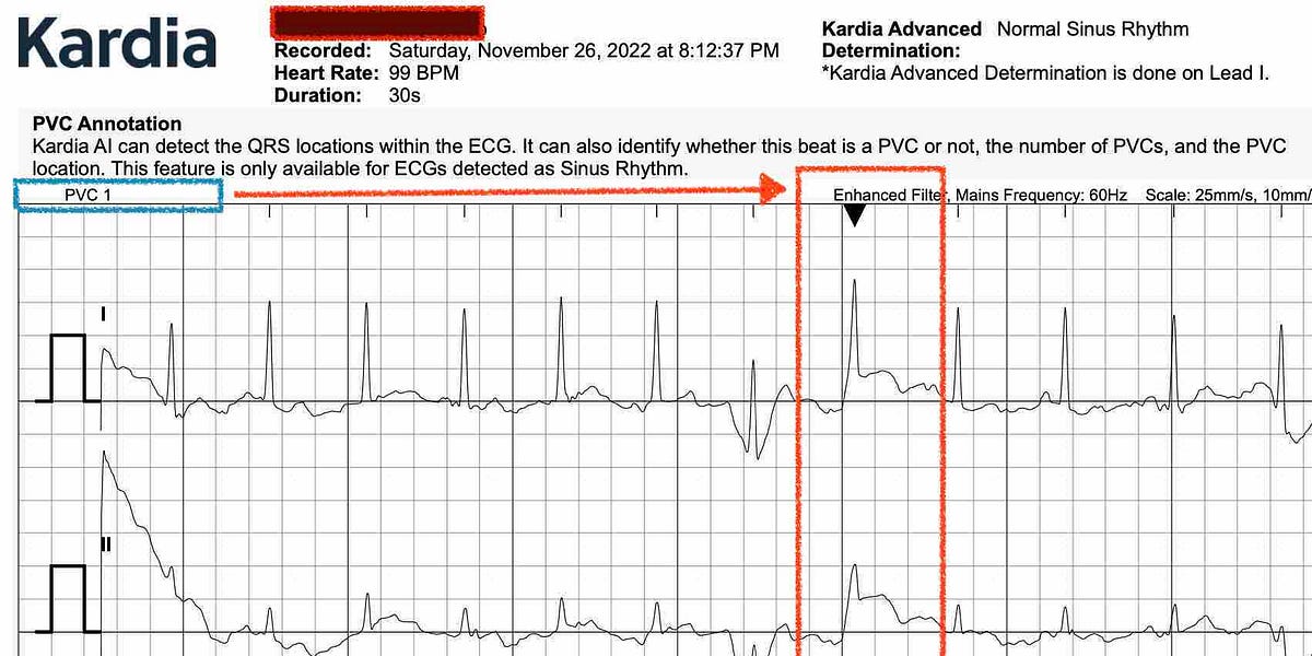 For Patients With Palpitations and PVCs Kardia's Determinations Can Be ...