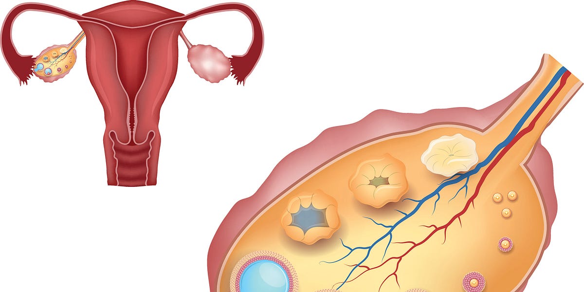 Spotlight on Primary Ovarian Insufficiency