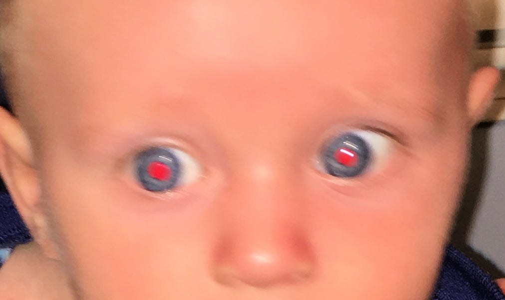 Pediatric Pearls Infant's Eye Part 2 Color, Discharge and Red Reflexes