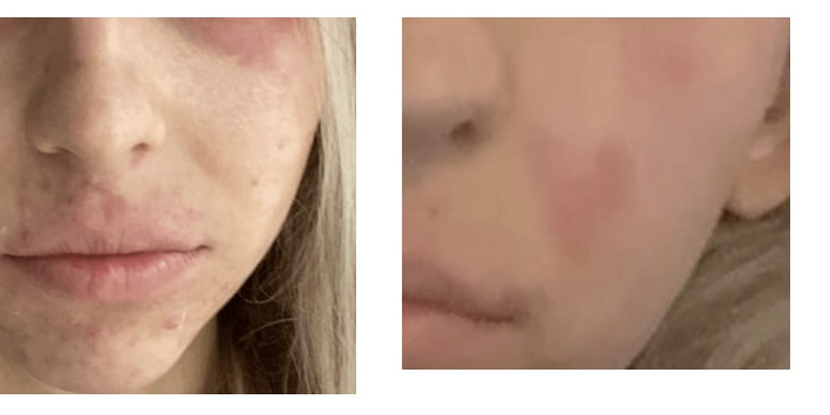 Opistorchiasis – a hidden health danger in Thailand for tourists: After