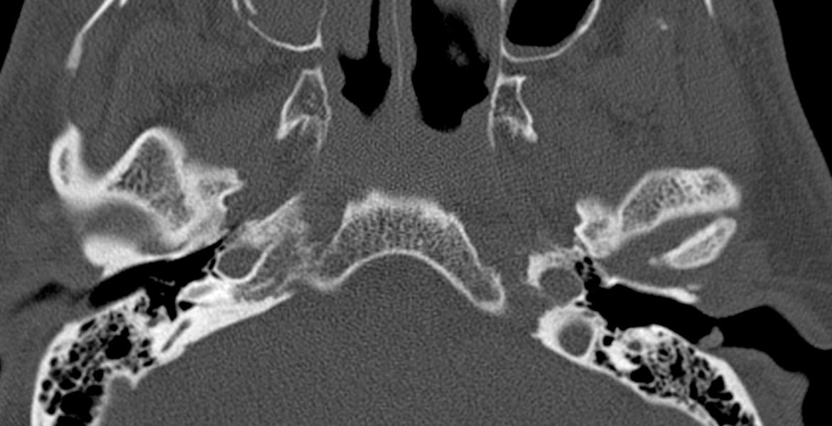 Complex Fracture by Alexander Baxter